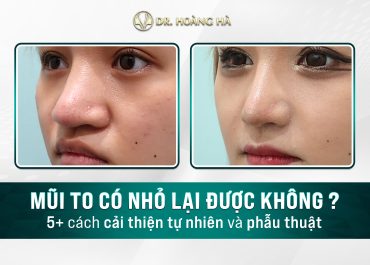 Mũi to có nhỏ lại được không? 5+ Cách cải thiện tự nhiên và phẫu thuật