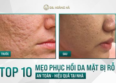 Top 10 mẹo phục hồi da mặt bị rỗ AN TOÀN mà HIỆU QUẢ tại nhà