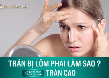 Trán bị lõm phải làm sao? 7+ Nguyên nhân & 3 Cách cải thiện trán cao