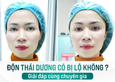 Độn thái dương có bị lộ không? Giải đáp cùng chuyên gia