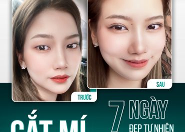 CẮT MÍ BABIE LINE - 7 NGÀY ĐẸP TỰ NHIÊN