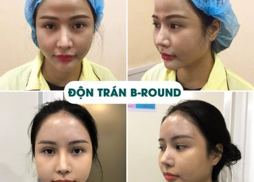 Độn trán có đau không? Tìm hiểu quy trình và cảm giác sau phẫu thuật