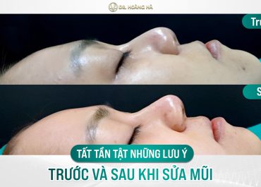 Tất tần tật những lưu ý trước và sau khi sửa mũi