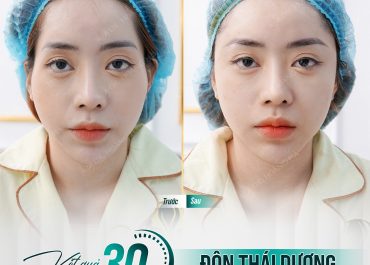THÁI DƯƠNG ĐẦY ĐẶN, ĐẸP TỰ NHIÊN NGAY SAU 30 PHÚT PHẪU THUẬT