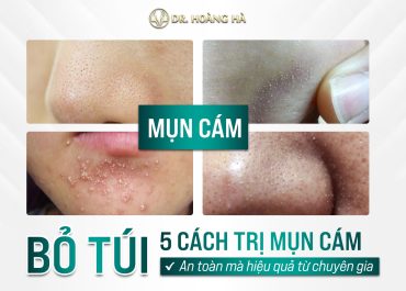 Bỏ túi 5 cách trị mụn cám ở mũi AN TOÀN mà HIỆU QUẢ từ chuyên gia 