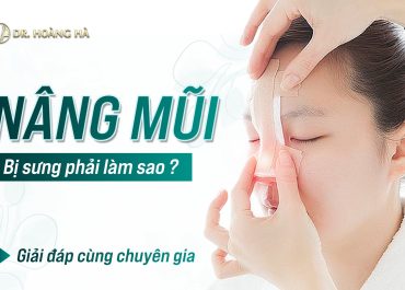 Nâng mũi chỉ bị sưng phải làm sao? Giải đáp cùng chuyên gia