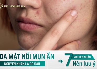 Da mặt nổi mụn ẩn nguyên nhân do đâu? 7+ nguyên nhân nên lưu ý