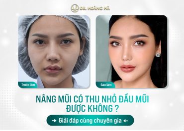 Nâng mũi rồi có thu nhỏ đầu mũi được không? Giải đáp cùng chuyên gia