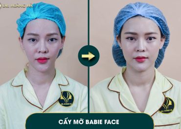 Cấy mỡ mặt có bị vón cục không? Dấu hiệu nhận biết và cách xử lý sớm 