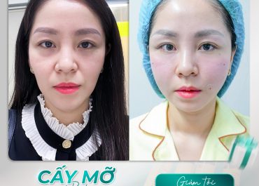  CẤY MỠ TỰ THÂN - CĂN CHỈNH LÕM HÓP