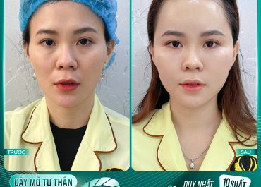 CẤY MỠ TỰ THÂN - TRẺ ĐẸP CHỈ SAU 60P 