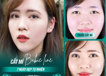 XINH ĐẸP HẾT NẤC VỚI CẮT MÍ BABIE LINE