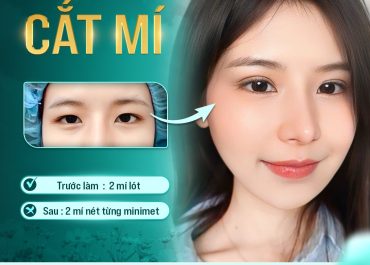 HÔ BIẾN MẮT MÍ LÓT THÀNH MẮT HAI MÍ TẠI DR. HOÀNG HÀ 