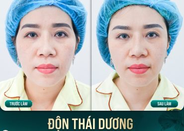 ĐỘN THÁI DƯƠNG – MẶT ĐẦY ĐẶN, NHAN SẮC THĂNG HẠNG 