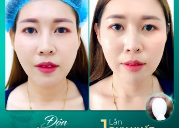 ĐỘN THÁI DƯƠNG – 1 LẦN DUY NHẤT, TẠM BIỆT LÕM HÓP BẨM SINH 