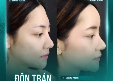 ĐỘN TRÁN CAO SANG – THẦN THÁI CHUẨN HÀN QUỐC 