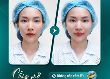 CẤY MỠ TỰ THÂN – CHẠM NHAN SẮC ĐỈNH TẠI DR. HOÀNG HÀ 