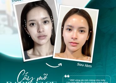 CẤY MỠ BABIE FACE & CẤY PRP: COMBO LÀM ĐẦY LÕM HÓP, HỒI SINH LÀN DA TƯƠI TRẺ GIÚP 