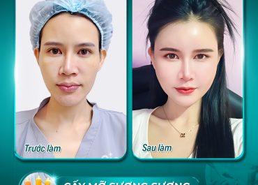 CẤY MỠ SƯƠNG SƯƠNG – NHAN SẮC THĂNG HẠNG NHƯ TỚI HÀN QUỐC ĐẬP ĐI XÂY LẠI