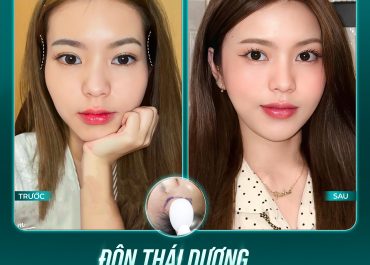 Độn thái dương – Thay đổi một chút, xinh lên rõ rệt 